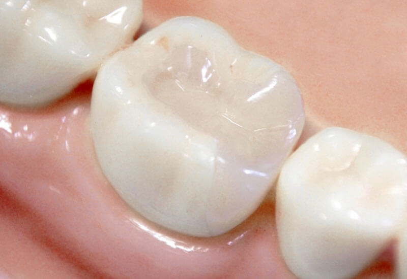 虫歯や歯周病のリスクが低い