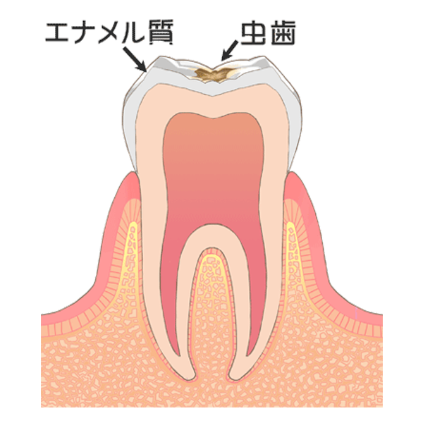 歯の表層（エナメル質）の虫歯
