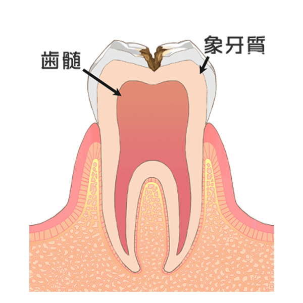 歯の中（象牙質）の虫歯