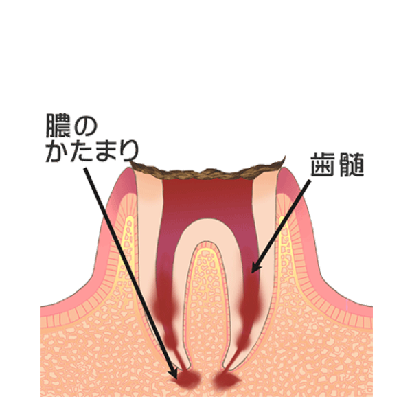 歯の根まで達した虫歯